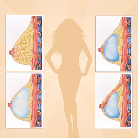 Augmentation mammaire 2 abdominoplastie tunisie, lifting tunisie, esthétique tunisie, rhinoplastie tunisie, lifting mammaire tunisie, augmentation mammaire tunisie, Chirurgie tunisie, clinique tunisie, chirurgie esthétique tunisie, lipofilling tunisie, opération tunisie, chirurgie homme tunisie
