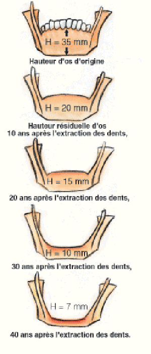 Implantologie dentaire 1 esthétique tunisie, clinique tunisie, abdominoplastie tunisie, rhinoplastie tunisie, chirurgie pas cher, liposuccion tunisie, opération tunisie, lifting tunisie, chirurgie esthétique tunisie, chirurgie homme tunisie, lipofilling tunisie, augmentation mammaire tunisie