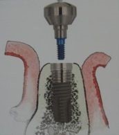 Implantologie dentaire 10 esthétique tunisie, clinique tunisie, abdominoplastie tunisie, rhinoplastie tunisie, chirurgie pas cher, liposuccion tunisie, opération tunisie, lifting tunisie, chirurgie esthétique tunisie, chirurgie homme tunisie, lipofilling tunisie, augmentation mammaire tunisie