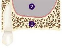 Implantologie dentaire 6 esthétique tunisie, clinique tunisie, abdominoplastie tunisie, rhinoplastie tunisie, chirurgie pas cher, liposuccion tunisie, opération tunisie, lifting tunisie, chirurgie esthétique tunisie, chirurgie homme tunisie, lipofilling tunisie, augmentation mammaire tunisie