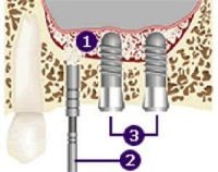 lifting tunisie, lifting mammaire tunisie, Chirurgie tunisie, lipofilling tunisie, clinique tunisie, esthétique tunisie, chirurgie mammaire tunisie, liposuccion tunisie, rhinoplastie tunisie, augmentation mammaire tunisie, chirurgie pas cher, chirurgie homme tunisie