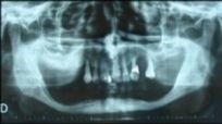 Implantologie dentaire 9 esthétique tunisie, clinique tunisie, abdominoplastie tunisie, rhinoplastie tunisie, chirurgie pas cher, liposuccion tunisie, opération tunisie, lifting tunisie, chirurgie esthétique tunisie, chirurgie homme tunisie, lipofilling tunisie, augmentation mammaire tunisie