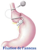 L’anneau gastrique 2 chirurgie pas cher, rhinoplastie tunisie, chirurgie mammaire tunisie, esthétique tunisie, lifting mammaire tunisie, clinique tunisie, liposuccion tunisie, augmentation mammaire tunisie, chirurgie esthétique tunisie, lifting tunisie, abdominoplastie tunisie