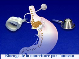 L’anneau gastrique 5 chirurgie pas cher, rhinoplastie tunisie, chirurgie mammaire tunisie, esthétique tunisie, lifting mammaire tunisie, clinique tunisie, liposuccion tunisie, augmentation mammaire tunisie, chirurgie esthétique tunisie, lifting tunisie, abdominoplastie tunisie