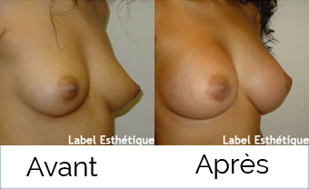 rhinoplastie tunisie, liposuccion tunisie, Chirurgie tunisie, lifting mammaire tunisie, lifting tunisie, augmentation mammaire tunisie, chirurgie homme tunisie, clinique tunisie, esthétique tunisie, chirurgie mammaire tunisie, lipofilling tunisie, chirurgie esthétique tunisie