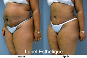 abdominoplastie tunisie, esthétique tunisie, chirurgie esthétique tunisie, liposuccion tunisie, augmentation mammaire tunisie, clinique tunisie, lifting mammaire tunisie, lifting tunisie, rhinoplastie tunisie, opération tunisie, Chirurgie tunisie, chirurgie mammaire tunisie