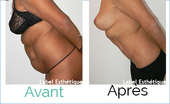 chirurgie pas cher, chirurgie esthétique tunisie, liposuccion tunisie, lifting tunisie, opération tunisie, chirurgie homme tunisie, abdominoplastie tunisie, esthétique tunisie, augmentation mammaire tunisie, clinique tunisie, lipofilling tunisie, chirurgie mammaire tunisie