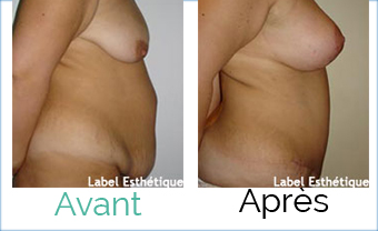 abdominoplastie tunisie, esthétique tunisie, chirurgie esthétique tunisie, liposuccion tunisie, augmentation mammaire tunisie, clinique tunisie, lifting mammaire tunisie, lifting tunisie, rhinoplastie tunisie, opération tunisie, Chirurgie tunisie, chirurgie mammaire tunisie