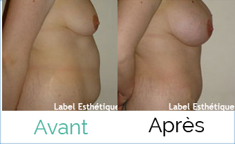 chirurgie mammaire tunisie, augmentation mammaire tunisie, abdominoplastie tunisie, lipofilling tunisie, lifting tunisie, Chirurgie tunisie, rhinoplastie tunisie, liposuccion tunisie, chirurgie pas cher, lifting mammaire tunisie, chirurgie homme tunisie, opération tunisie