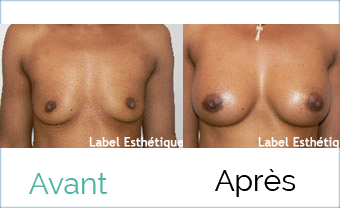 rhinoplastie tunisie, liposuccion tunisie, Chirurgie tunisie, lifting mammaire tunisie, lifting tunisie, augmentation mammaire tunisie, chirurgie homme tunisie, clinique tunisie, esthétique tunisie, chirurgie mammaire tunisie, lipofilling tunisie, chirurgie esthétique tunisie