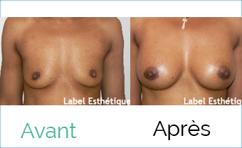 lifting tunisie, augmentation mammaire tunisie, chirurgie homme tunisie, Chirurgie tunisie, clinique tunisie, rhinoplastie tunisie, lipofilling tunisie, lifting mammaire tunisie, abdominoplastie tunisie, chirurgie pas cher, esthétique tunisie, chirurgie mammaire tunisie