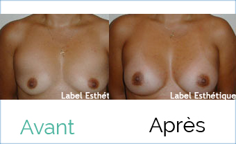rhinoplastie tunisie, liposuccion tunisie, Chirurgie tunisie, lifting mammaire tunisie, lifting tunisie, augmentation mammaire tunisie, chirurgie homme tunisie, clinique tunisie, esthétique tunisie, chirurgie mammaire tunisie, lipofilling tunisie, chirurgie esthétique tunisie