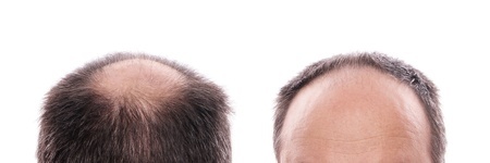 Greffes de cheveux 2 abdominoplastie tunisie, clinique tunisie, chirurgie pas cher, chirurgie mammaire tunisie, opération tunisie, liposuccion tunisie, Chirurgie tunisie, chirurgie homme tunisie, lipofilling tunisie, lifting mammaire tunisie, esthétique tunisie, lifting tunisie