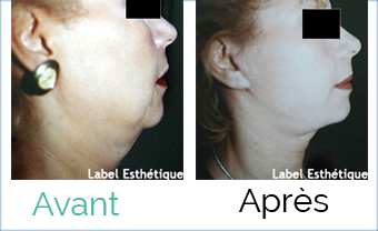 lifting tunisie, augmentation mammaire tunisie, Chirurgie tunisie, opération tunisie, rhinoplastie tunisie, lifting mammaire tunisie, chirurgie pas cher, liposuccion tunisie, clinique tunisie, chirurgie homme tunisie, lipofilling tunisie, esthétique tunisie