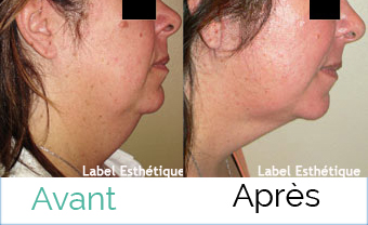 lifting tunisie, augmentation mammaire tunisie, Chirurgie tunisie, opération tunisie, rhinoplastie tunisie, lifting mammaire tunisie, chirurgie pas cher, liposuccion tunisie, clinique tunisie, chirurgie homme tunisie, lipofilling tunisie, esthétique tunisie