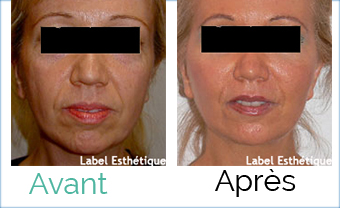 lifting tunisie, augmentation mammaire tunisie, Chirurgie tunisie, opération tunisie, rhinoplastie tunisie, lifting mammaire tunisie, chirurgie pas cher, liposuccion tunisie, clinique tunisie, chirurgie homme tunisie, lipofilling tunisie, esthétique tunisie