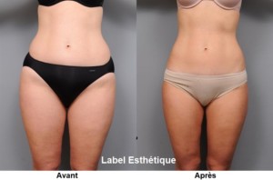 Chirurgie tunisie, opération tunisie, chirurgie pas cher, liposuccion tunisie, esthétique tunisie, lifting mammaire tunisie, lipofilling tunisie, clinique tunisie, chirurgie esthétique tunisie, chirurgie homme tunisie, rhinoplastie tunisie, lifting tunisie