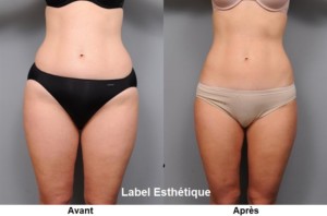 lifting tunisie, liposuccion tunisie, esthétique tunisie, chirurgie esthétique tunisie, clinique tunisie, chirurgie homme tunisie, abdominoplastie tunisie, chirurgie pas cher, augmentation mammaire tunisie, rhinoplastie tunisie, chirurgie mammaire tunisie