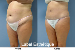 Chirurgie tunisie, opération tunisie, chirurgie pas cher, liposuccion tunisie, esthétique tunisie, lifting mammaire tunisie, lipofilling tunisie, clinique tunisie, chirurgie esthétique tunisie, chirurgie homme tunisie, rhinoplastie tunisie, lifting tunisie