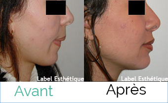 opération tunisie, lipofilling tunisie, liposuccion tunisie, esthétique tunisie, chirurgie mammaire tunisie, chirurgie homme tunisie, augmentation mammaire tunisie, lifting tunisie, abdominoplastie tunisie, Chirurgie tunisie, chirurgie pas cher, rhinoplastie tunisie