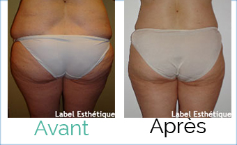 lifting tunisie, liposuccion tunisie, esthétique tunisie, chirurgie esthétique tunisie, clinique tunisie, chirurgie homme tunisie, abdominoplastie tunisie, chirurgie pas cher, augmentation mammaire tunisie, rhinoplastie tunisie, chirurgie mammaire tunisie