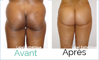 lifting tunisie, liposuccion tunisie, esthétique tunisie, chirurgie esthétique tunisie, clinique tunisie, chirurgie homme tunisie, abdominoplastie tunisie, chirurgie pas cher, augmentation mammaire tunisie, rhinoplastie tunisie, chirurgie mammaire tunisie