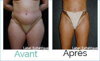 lifting tunisie, liposuccion tunisie, esthétique tunisie, chirurgie esthétique tunisie, clinique tunisie, chirurgie homme tunisie, abdominoplastie tunisie, chirurgie pas cher, augmentation mammaire tunisie, rhinoplastie tunisie, chirurgie mammaire tunisie