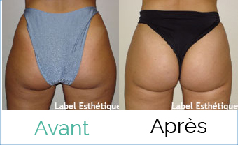 lifting tunisie, liposuccion tunisie, esthétique tunisie, chirurgie esthétique tunisie, clinique tunisie, chirurgie homme tunisie, abdominoplastie tunisie, chirurgie pas cher, augmentation mammaire tunisie, rhinoplastie tunisie, chirurgie mammaire tunisie