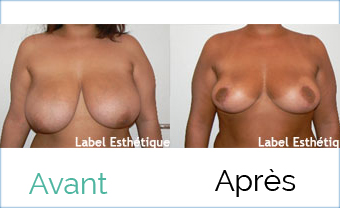liposuccion tunisie, chirurgie homme tunisie, chirurgie pas cher, lipofilling tunisie, abdominoplastie tunisie, clinique tunisie, chirurgie mammaire tunisie, lifting tunisie, augmentation mammaire tunisie, rhinoplastie tunisie, Chirurgie tunisie, esthétique tunisie