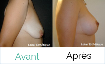 chirurgie mammaire tunisie, augmentation mammaire tunisie, chirurgie esthétique tunisie, rhinoplastie tunisie, chirurgie pas cher, esthétique tunisie, liposuccion tunisie, lipofilling tunisie, abdominoplastie tunisie, chirurgie homme tunisie, clinique tunisie