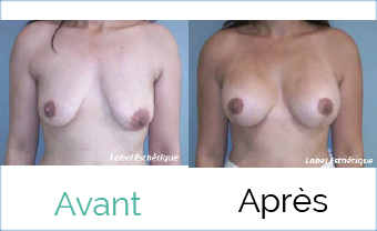 liposuccion tunisie, opération tunisie, abdominoplastie tunisie, chirurgie mammaire tunisie, chirurgie homme tunisie, chirurgie pas cher, lifting tunisie, chirurgie esthétique tunisie, augmentation mammaire tunisie, esthétique tunisie, Chirurgie tunisie