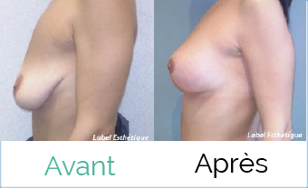 liposuccion tunisie, opération tunisie, abdominoplastie tunisie, chirurgie mammaire tunisie, chirurgie homme tunisie, chirurgie pas cher, lifting tunisie, chirurgie esthétique tunisie, augmentation mammaire tunisie, esthétique tunisie, Chirurgie tunisie