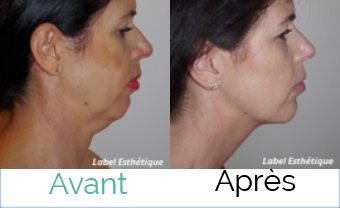 chirurgie pas cher, chirurgie homme tunisie, lipofilling tunisie, clinique tunisie, rhinoplastie tunisie, liposuccion tunisie, opération tunisie, augmentation mammaire tunisie, lifting tunisie, esthétique tunisie, chirurgie esthétique tunisie, Chirurgie tunisie