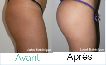 lifting tunisie, abdominoplastie tunisie, lipofilling tunisie, liposuccion tunisie, chirurgie mammaire tunisie, augmentation mammaire tunisie, rhinoplastie tunisie, clinique tunisie, lifting mammaire tunisie, opération tunisie, chirurgie esthétique tunisie