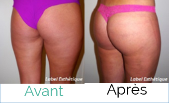 lifting tunisie, abdominoplastie tunisie, lipofilling tunisie, liposuccion tunisie, chirurgie mammaire tunisie, augmentation mammaire tunisie, rhinoplastie tunisie, clinique tunisie, lifting mammaire tunisie, opération tunisie, chirurgie esthétique tunisie