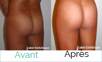 lifting tunisie, abdominoplastie tunisie, lipofilling tunisie, liposuccion tunisie, chirurgie mammaire tunisie, augmentation mammaire tunisie, rhinoplastie tunisie, clinique tunisie, lifting mammaire tunisie, opération tunisie, chirurgie esthétique tunisie