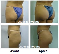 lifting tunisie, abdominoplastie tunisie, lipofilling tunisie, liposuccion tunisie, chirurgie mammaire tunisie, augmentation mammaire tunisie, rhinoplastie tunisie, clinique tunisie, lifting mammaire tunisie, opération tunisie, chirurgie esthétique tunisie