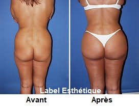 lifting tunisie, abdominoplastie tunisie, lipofilling tunisie, liposuccion tunisie, chirurgie mammaire tunisie, augmentation mammaire tunisie, rhinoplastie tunisie, clinique tunisie, lifting mammaire tunisie, opération tunisie, chirurgie esthétique tunisie