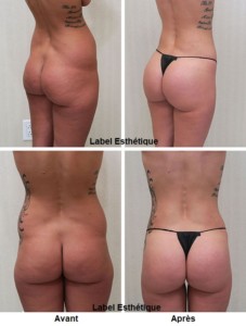 lifting tunisie, abdominoplastie tunisie, lipofilling tunisie, liposuccion tunisie, chirurgie mammaire tunisie, augmentation mammaire tunisie, rhinoplastie tunisie, clinique tunisie, lifting mammaire tunisie, opération tunisie, chirurgie esthétique tunisie